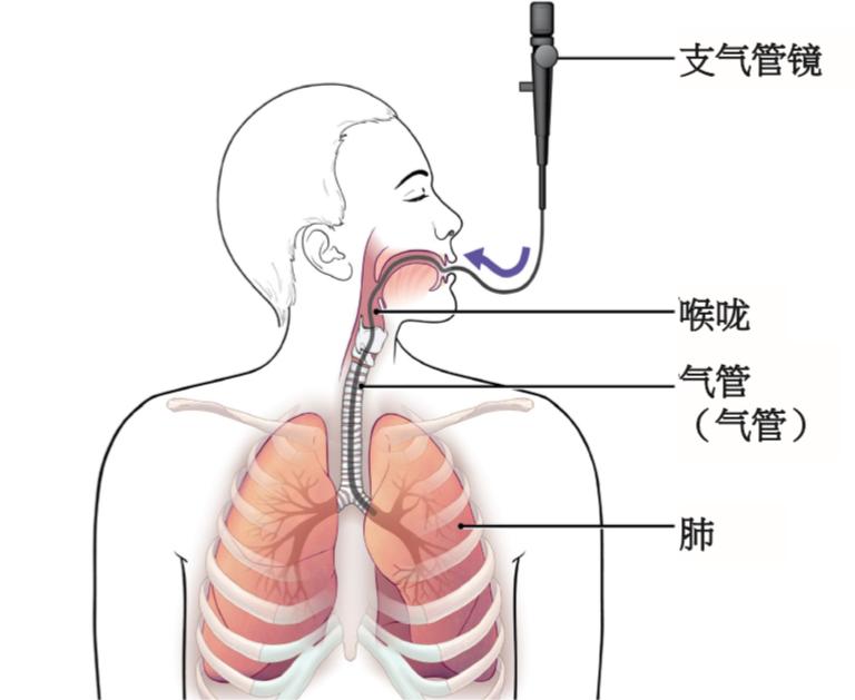 鼹鼠医疗视角下：颈椎固定患者可视喉镜与纤支镜气管插管的比较